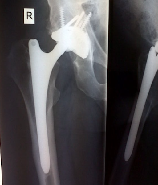 Austria Hip Systems Logimed Total Hip Prosthesis (Implant 4286)